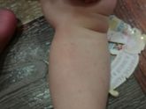 После темпиратуры на теле