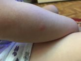 Ветрянка или нет?