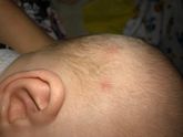 У малыша на голове 2 красных пятна