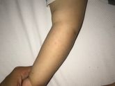 Сыпануло или потничка☹️