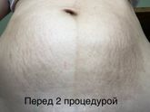 Борьба с растяжками. 2 шлифовка