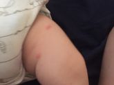 За день пятна покраснели,