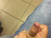 Гематома под ногтем у ребенка