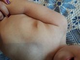 Подскажите симптомы краснухи.