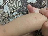 Кожа на ногах