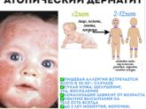 Про аллергию!