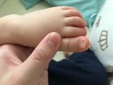 Ногти на ногах стали вогнутые