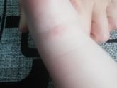 Сыпь?