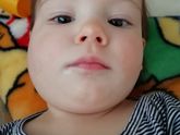 Синюшность в области 1 моляра
