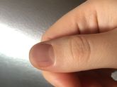 На ногте чёрная полоска
