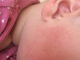 Аллергия или обветренные щеки?