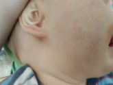 Реакция на адвантан , у кого было?