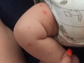 За день пятна покраснели,
