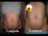 Все кого беспокоят обвисший живот и растяжки!!!