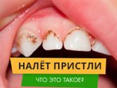 ТЕМНЫЙ НАЛЕТ НА ЗУБАХ - НАЛЕТ ПРИСТЛИ