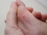 SOS! Что это за прыщи? Кто сталкивался?