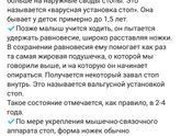 Вальгус.