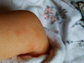 Алеергия?Акне? Цветение? Дерматит?