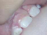Дисплазия эмали молочных зубов!
