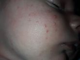 Потничка или аллергия?