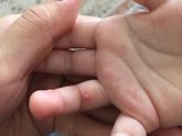 Волдыри на руках