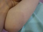 Аллергия на кабачок. Что дальше?