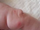 прыщи (укус или аллергия ?