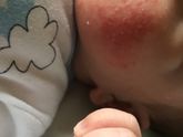 Сыпь на щечках