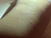 Сыпь и кашель