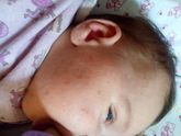 Аллергия на смесь или
