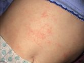 Диатез или аллергия?
