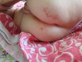 Девочки и малышки появились вот такие покраснения на попке что это? Чем мазать