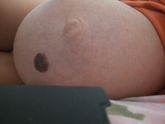 Удаление Большой родинки, кто это делал?