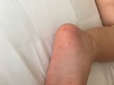 Сыпь похожая на розеолу