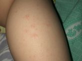 Потничка/аллергия/крапивница