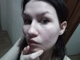 Красные пятна на лице внезапно.