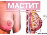 Мастит