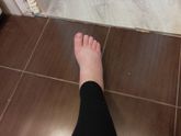 Начались сильные отеки на