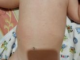 Аллергия на коровий белок., какие симптомы??
