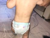 Потничка или аллергия?