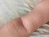 Потница или аллергия ?