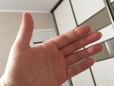 Отеки! Нужна ли госпитализация?!