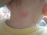 Детский дерматолог Энгельс