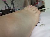SOS!!!!! Ушиб