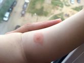 Высыпания help!