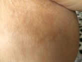 Такая коричневая пигментация