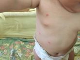 Аллергия или покусали?