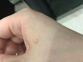 Может проколоть?
