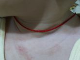 Покраснения