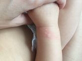 Волдырики появляются и исчезают